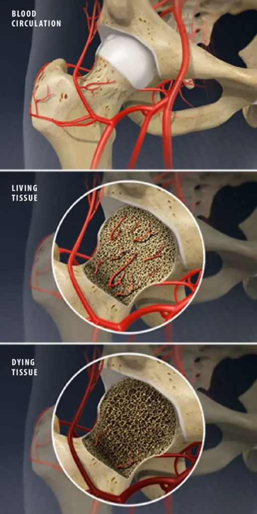 Avascular Necrosis AVN of the Hip