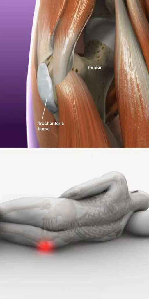 Bursitis of the Hip Trochanteric Bursitis