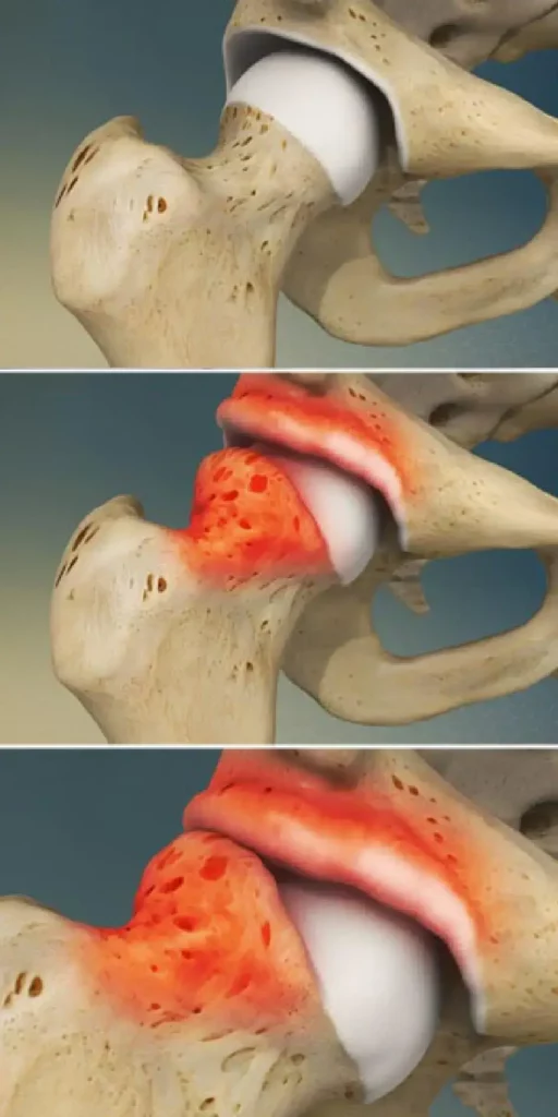 Femoral-Acetabular Impingement FAI