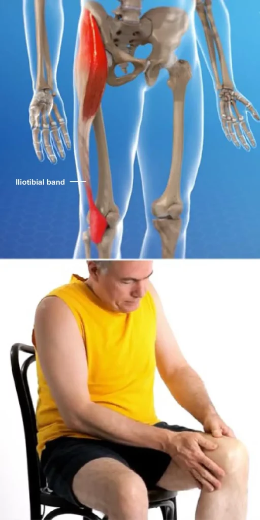 Iliotibial Band Syndrome ITBS