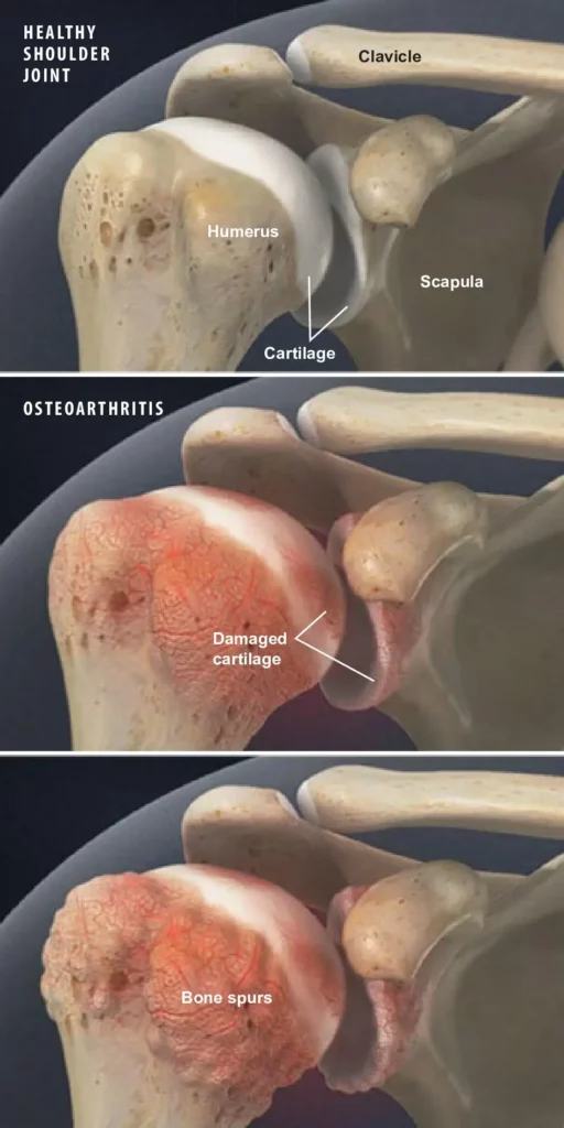 Osteoarthritis of the Shoulder